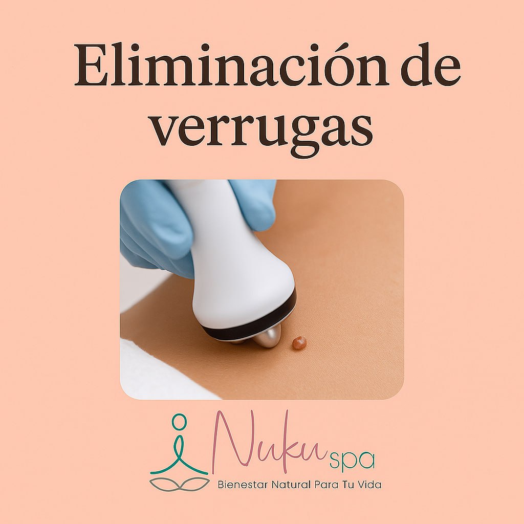 Eliminación de verrugas en Pachuca – Nuku Spa
